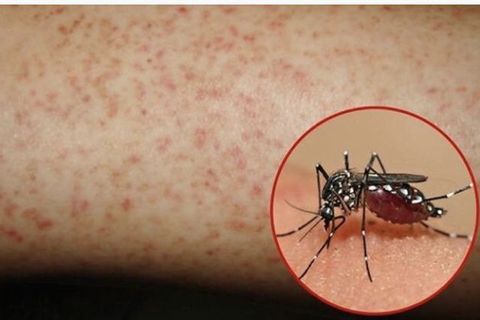 Cảnh báo: Nhiều trẻ em sốt xuất huyết nguy kịch do nhập viện muộn