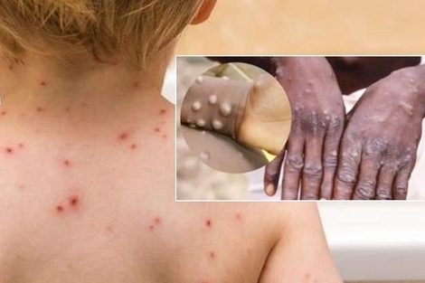 Bệnh đậu mùa khỉ là gì và lây qua đường nào?